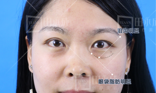 银川田永成整形祛眼袋案例：成为整形医生的妻子是一种怎样的体验