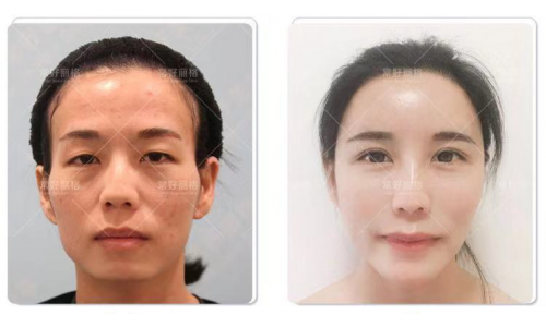 脂肪移植医生郭昌灏解析：自体脂肪怎么填能避免包子脸！