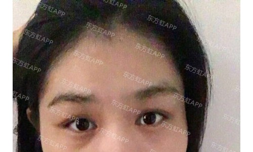 厦门修志夫做鼻子怎么样？分享我的隆鼻经历