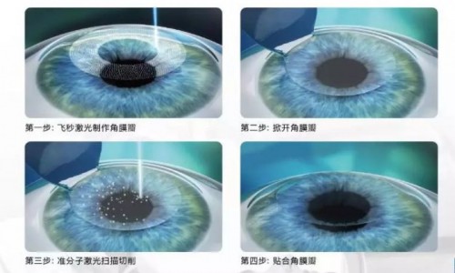 上海和平眼科医院做近视手术好不好？2020年报名开始近视眼姑娘应征一试!