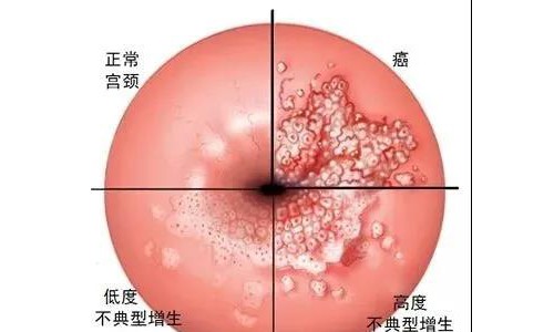 「宫颈癌筛查」北京五洲妇儿医院女人记得定期做这项检查