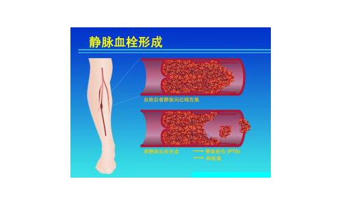 济南静脉曲张哪里看得最好山东