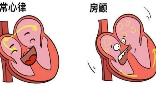 房颤患者如何选择抗凝药物